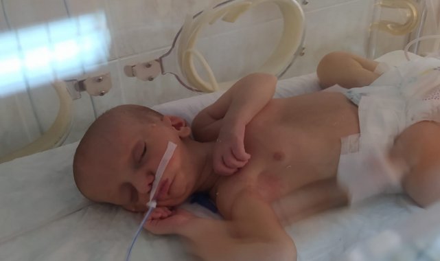 MHP ve AK Parti, doğuştan dudakları yapışık olan Umut bebek için seferber oldu